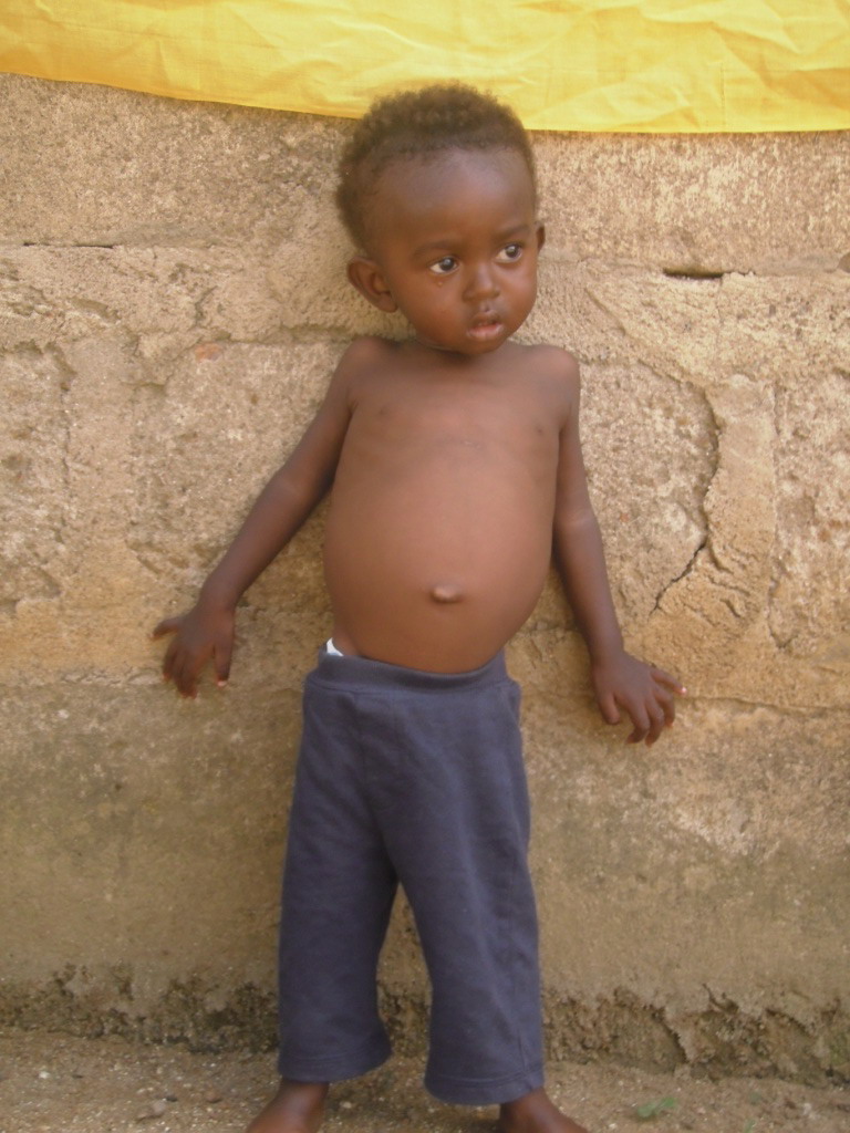 Malnourished Child gets help